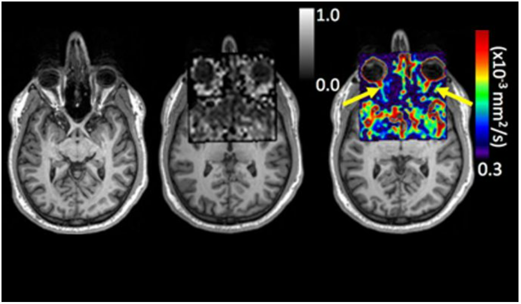 Addressing the most challenging tissues in magnetic resonance image