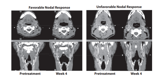 A Phase 2 Exploratory Trial Evaluating Computed Tomography.png