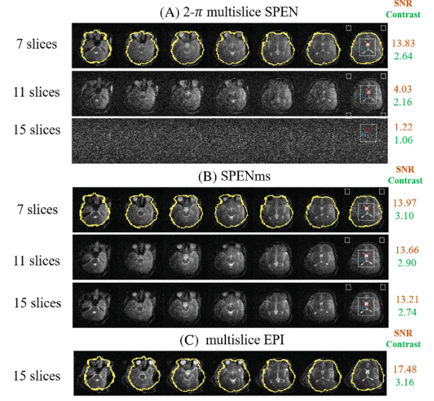 A new approach for multislice spatiotemporal encoding MRI in a portable low‐field system.png