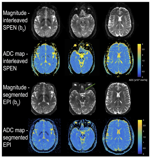 A regularized reconstruction pipeline for high‐definition diffusion MRI in challenging regions incorporating a per‐shot image correction.png