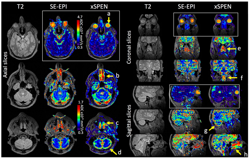 Diffusion MRI measurements in challenging head and brain regions via cross-term spatiotemporally encoding.png