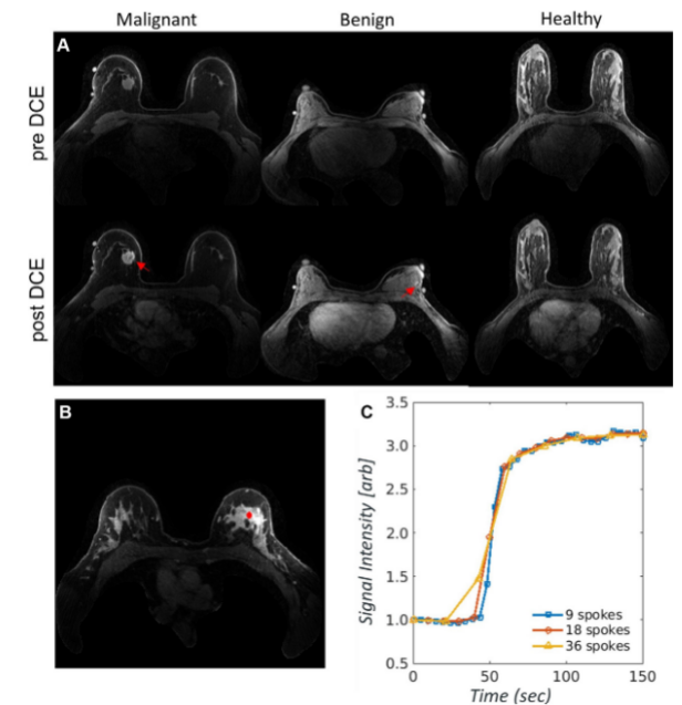FastMRI Breast A Publicly Available Radial k-Space Dataset of Breast Dynamic Contrast-enhanced MRI.png