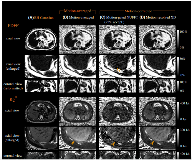 Free‐breathing fat and quantification in the liver using a stack‐of‐stars multi‐echo acquisition with respiratory‐resolved model‐based reconstruction.png