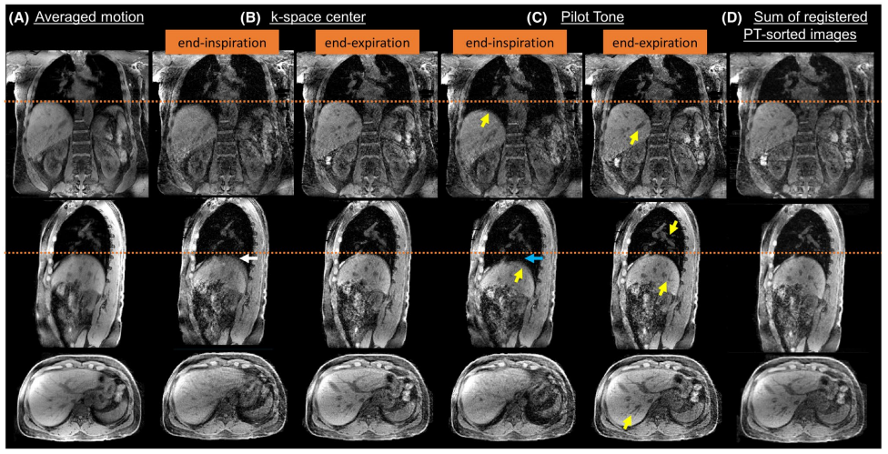 Free‐breathing radial imaging using a pilot‐tone radiofrequency transmitter for detection of respiratory motion.png