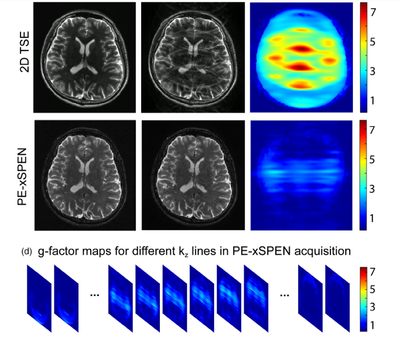 High-Accelerated Parallel Imaging With the Inherent Local Feature in PE-xSPEN MRI.png
