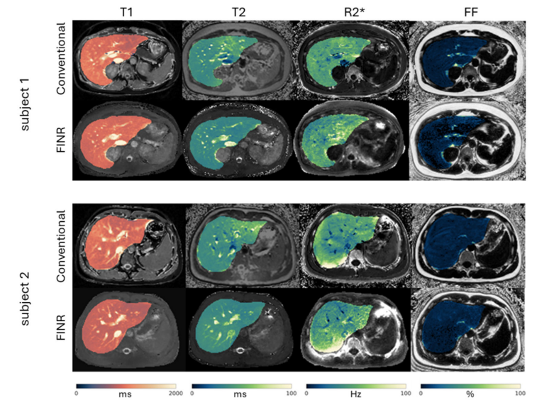 Navigator motion-resolved MR fingerprinting using implicit neural representation (FINR) feasibility for free-breathing 3D whole-liver multiparametric mapping.png