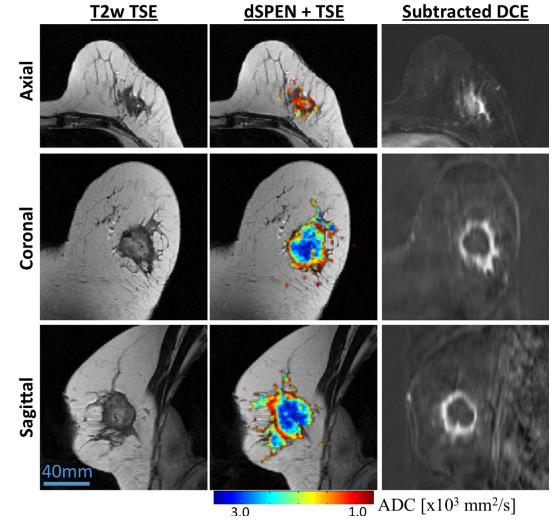 Overcoming limitations in diffusionweighted MRI of breast by spatiotemporal encoding.png