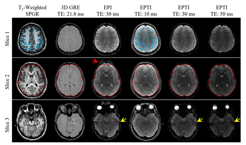 Rapid quantitative susceptibility mapping using single-shot echo planar time-resolved imaging.png