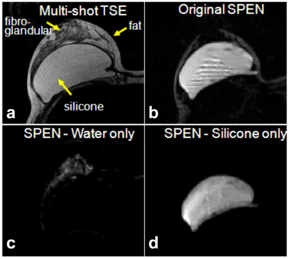Removing Silicone Artifacts in Diffusion‐Weighted Breast MRI by Means of Shift‐Resolved Spatiotemporally Encoding.png