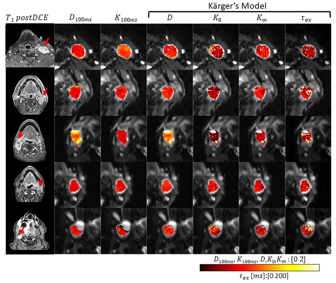 Time‐dependent diffusivity and kurtosis in phantoms and patients with head and neck cancer.png